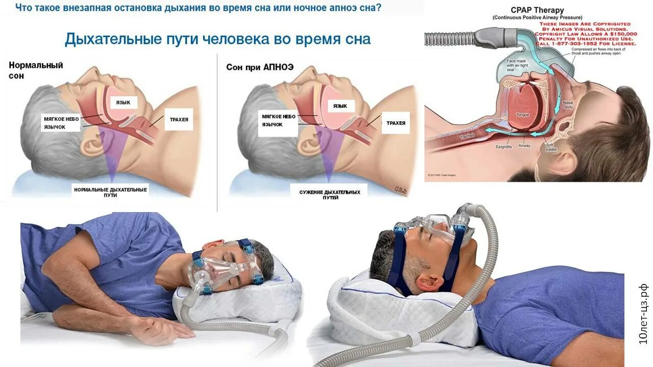 СРАР аппарат. СРАР аппарат для новорожденных.