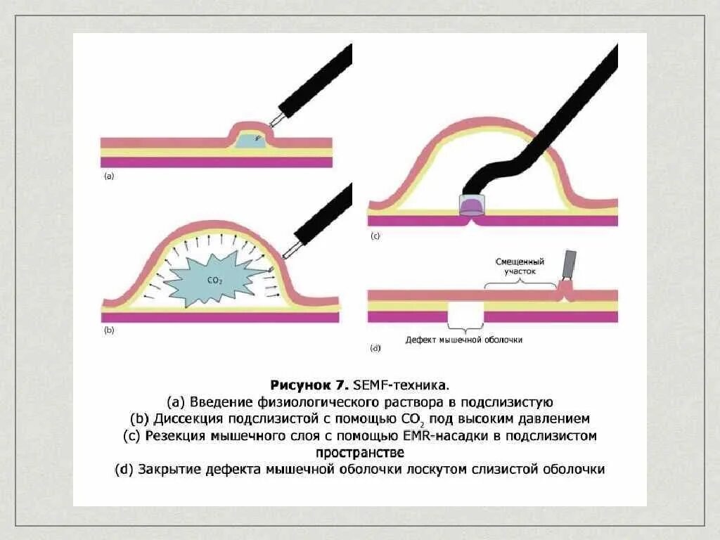 Подслизистая диссекция. Диссекция в подслизистом слое. Эндоскопическая диссекция. Эндоскопическая подслизистая диссекция. Операция удаления опухоли желудка