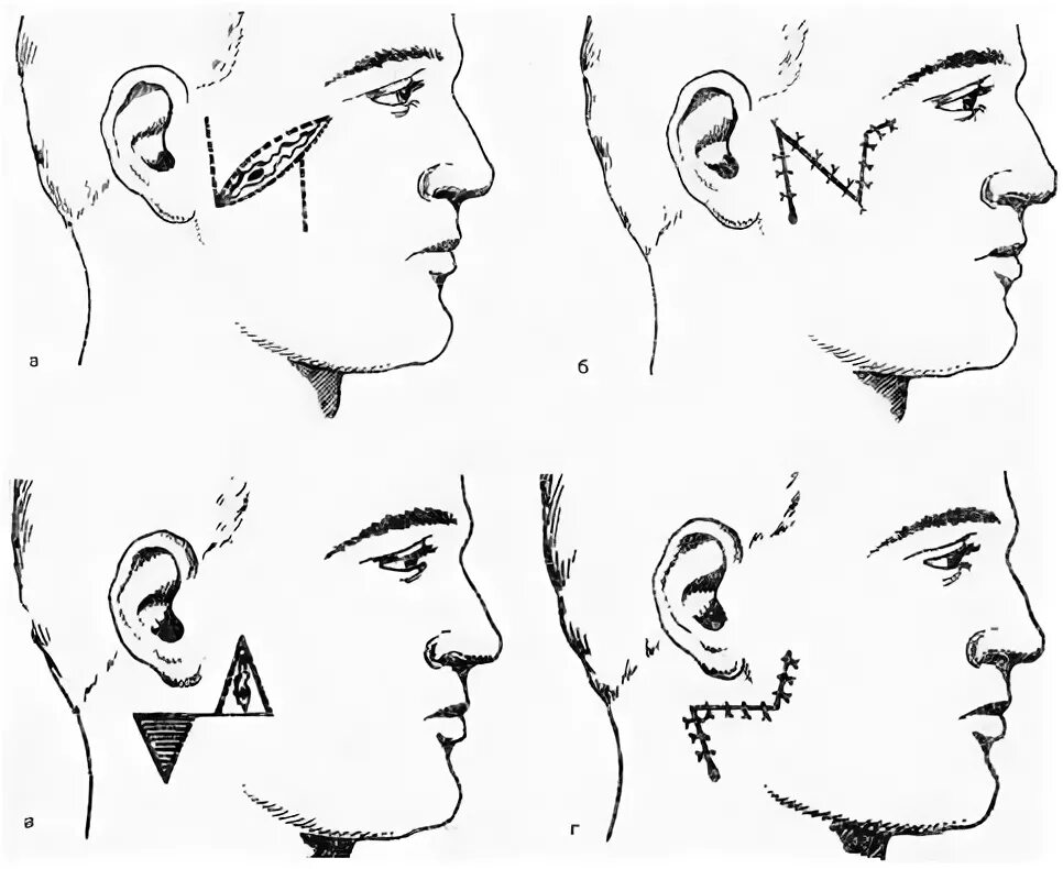 Околоушная железа операция. Встречных Лоскутов по а. а. Лимбергу.. Пластика встречными треугольными лоскутами (метод а.а.Лимберга),. Пластика встречными треугольными лоскутами ЧЛХ.