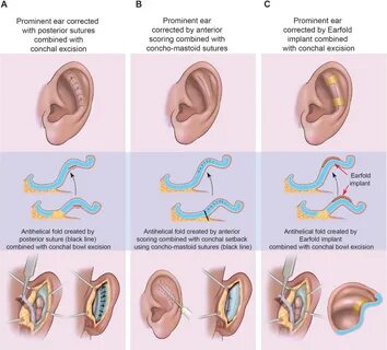 Protruding ears