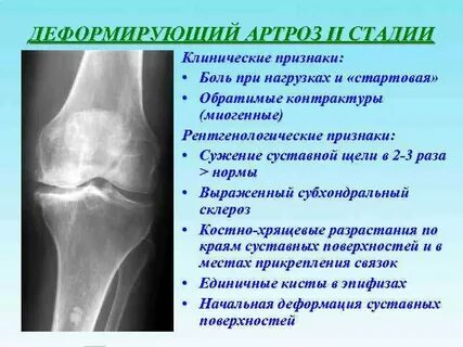 Признаки остеоартроза 1 2 степени