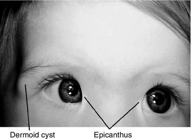 Стигмы дисэмбрионееза. Анкилоблефарон колобома. Узкая глазная щель. Разрез глаз эпикантус. Фестивальный алкогольный синдром.