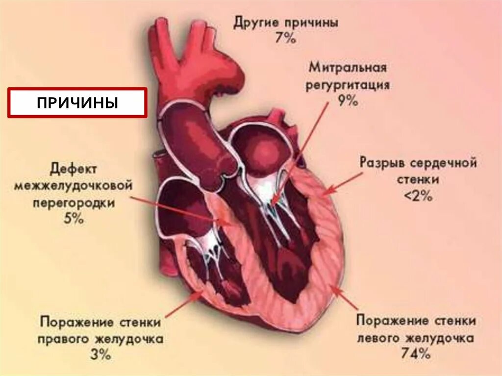 Сердце при кардиогенном шоке. Кардиогенный ШОК презентация. Кардиогенный ШОК этиология. Причины развития миокардита. Миокард правого желудочка сердца