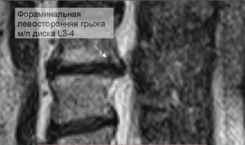 Левосторонняя грыжа диска