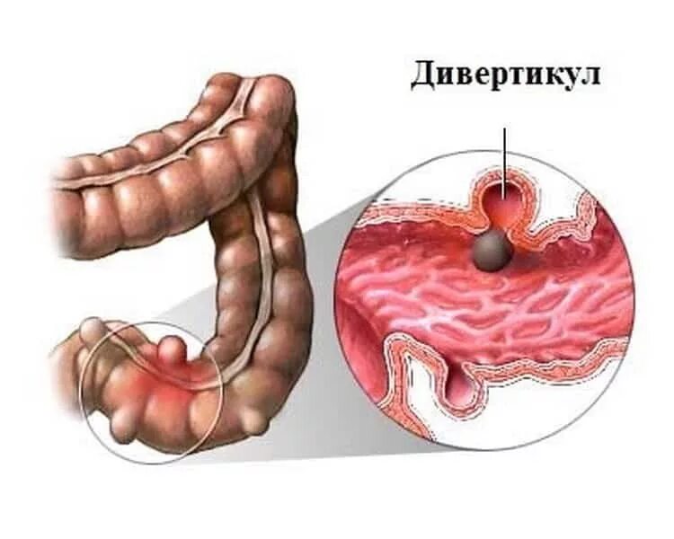 Что такое дивертикулез
