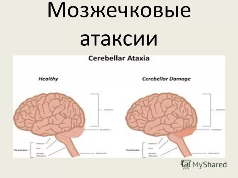 Корковая лобная атаксия. Церебеллярная дегенерация. Мозжечковая атаксия. Атаксия мозга. Виды атаксий.