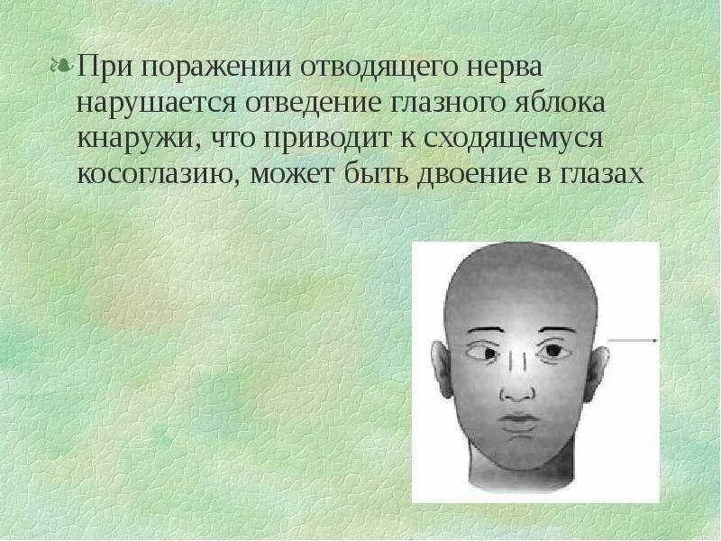Парез отводящего. Неврит отводящего нерва симптомы. симптомы поражения отводящего нерва неврология. при поражении отводящего нерва. изолированное поражение отводящего нерва.