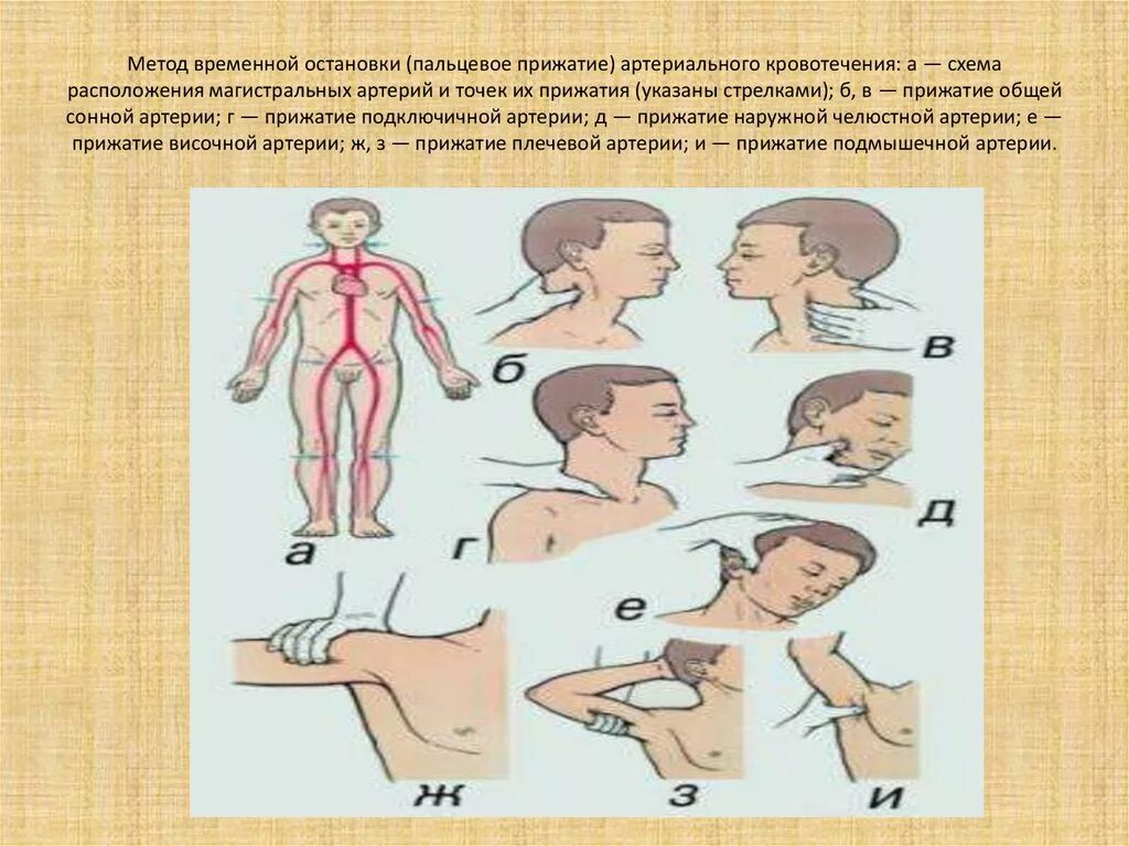 Способы остановки кровотечения лица. Схема остановки кровотечения. Точки прижатия кровотечения. Способы остановки артериального кровотечения. Способы временной остановки кровотечения из сонной артерии.