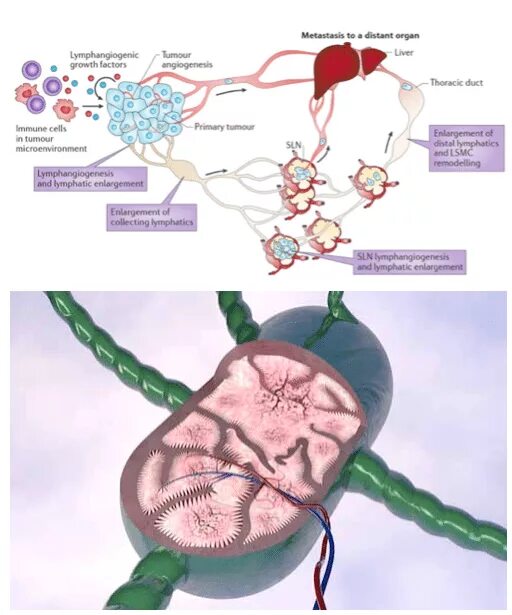 Лимфоузел после химиотерапии. Метастазы в лимфоузлах схема. Метастазирование в лимфатические узлы. Схема метастаза в лимфоузле.