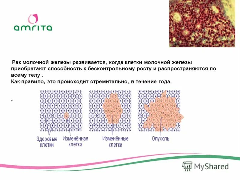 Grade 2 молочной железы. стадии рмж. классификация стадий онкологии молочной железы. Grade 2 молочной железы. карцинома молочной железы 2 стадия.