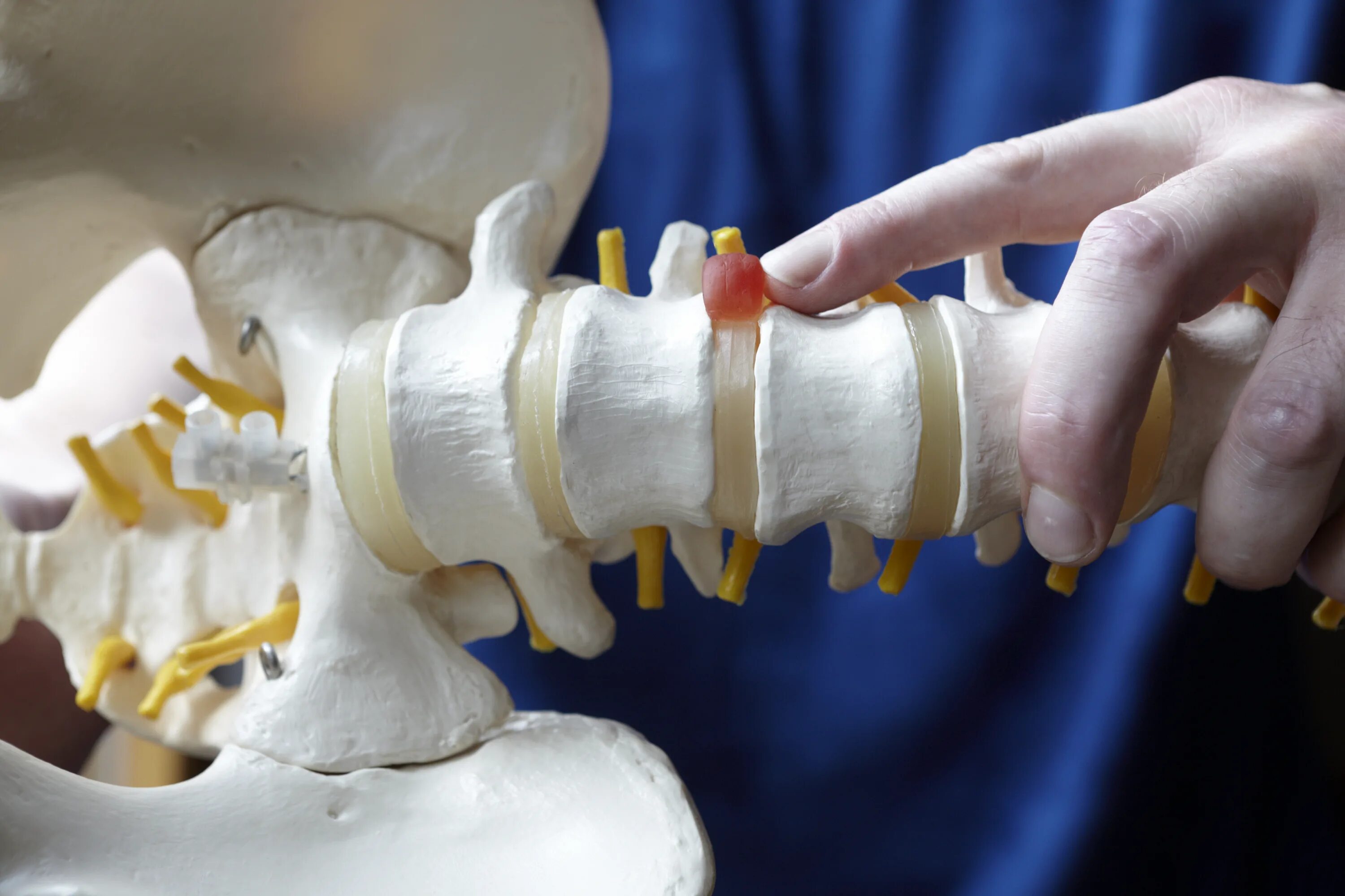 Межпозвонковая грыжа без операции. Нуклеопластика грыжи позвоночника. Нуклеопластика межпозвонкового диска. Искусственный позвоночник. Макет позвоночника с грыжей.