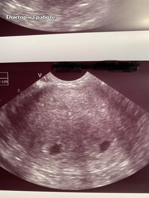 Матка 35 мм. Двурогая матка беременность аборт. Беременность при двурогой матке.