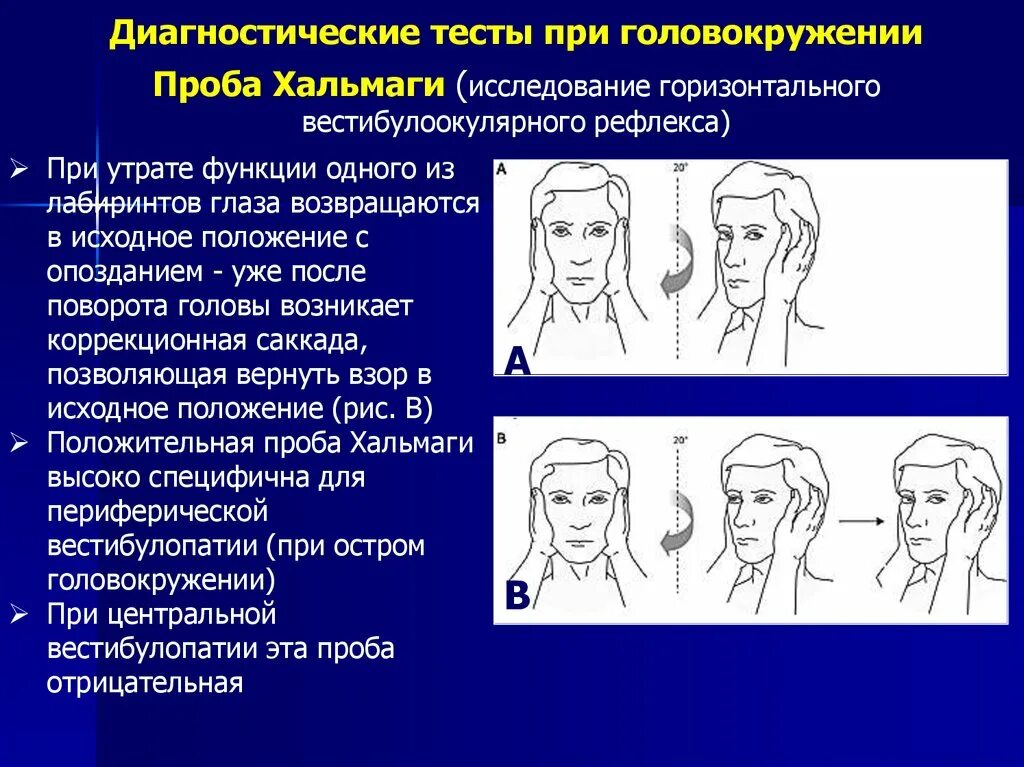 Хальмаги кертойза. Тест при головокружении. Пробы при головокружении. Исследование вестибулоокулярных рефлексов. Поднимаю голову кружится голова