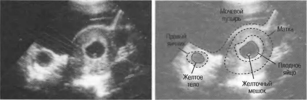 Матка на 1 неделе беременности. Желтое тело в яичнике и плодное яйцо. Плодное яйцо 7 недель на УЗИ В матке. УЗИ признаки остатков плодного яйца. УЗИ матки на 7 неделе беременности.