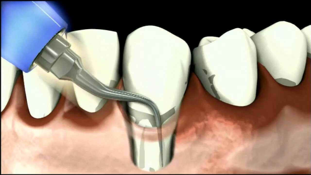 Кюретаж пародонтальных карманов. Пародонтит зубной камень. Кюретаж пародонтальных карманов аппаратом вектор. Вакуум кюретаж стоматология. Как чистить десна