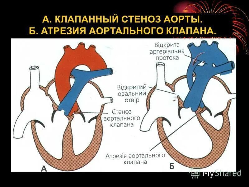 Аортальный стеноз что это такое. Коарктация аорты и аортальный стеноз. Коарктация клапана аорты. Аортальный клапанный стеноз. Стеноз и атрезия легочной артерии.