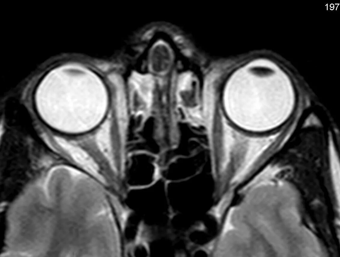 Глазных орбит и зрительных нервов. МСКТ орбит глаза. Мрт глазных орбит. Мрт глазных орбит фотоаппарат. Кт глаза.