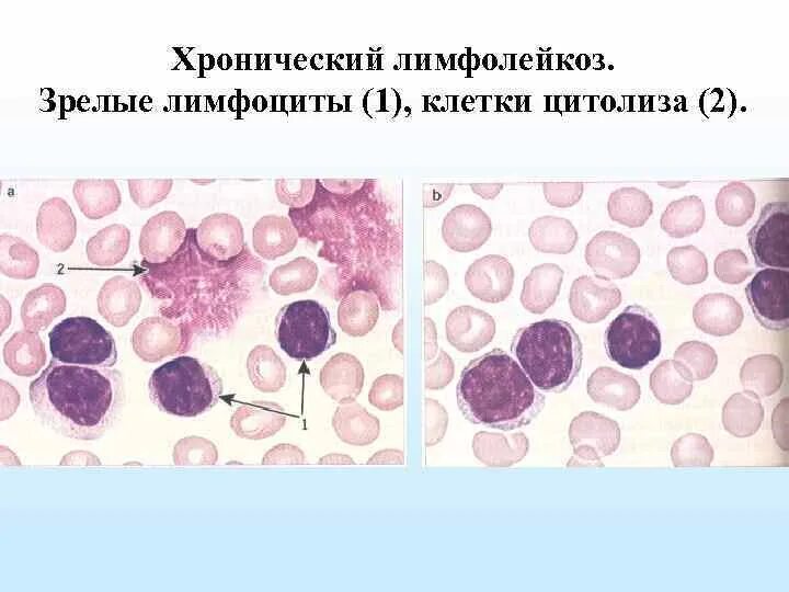 B хронический лимфолейкоз. Тени Боткина Гумпрехта. Клетки Боткина Гумпрехта это. Клетки лейколиза (тени Боткина-Гумпрехта). В -лимфоциты хронический лимфолейкоз.