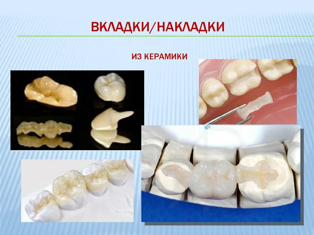 Вкладка керамическая (inlay, onlay, overlay, pinlay). Керамическая накладка на зуб. Керамическая вкладка e-max inlay onlay. Керамическая e max emax вкладка. Керамические зубные вкладки.