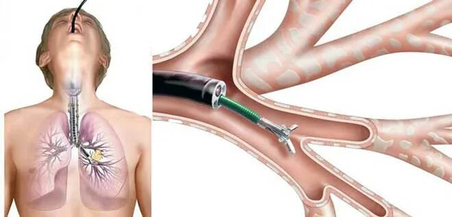 Бронхоскопия и бронхография. Бронхоскопия эндоскопическое исследование бронхов. Санационная фибробронхоскопия. Гангрена легкого бронхоскопия. Биопсия легких как проводится