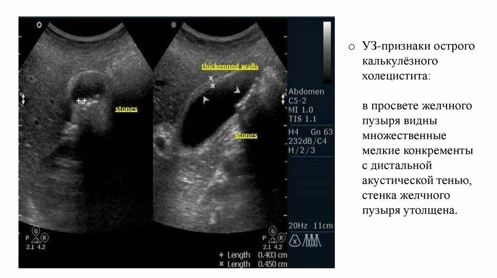 Острый калькулезный холецистит на УЗИ. Хронический калькулезный холецистит УЗИ. ЖКБ острый калькулезный холецистит УЗИ. УЗИ желчного пузыря калькулезный холецистит. Эхо признаки желчного пузыря