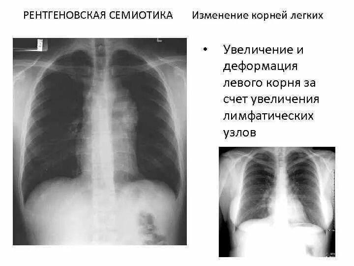 Легкие увеличен узел. Расширенный корень легкого на рентгене. Увеличение корня легкого. Изменения корня легких на рентгенограмме. Лимфоузлы корня легкого.