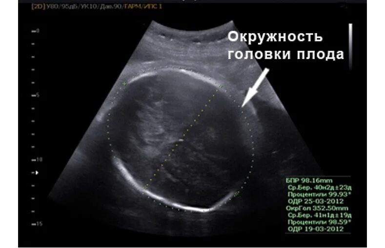 Измерение окружности живота плода УЗИ. Окружность головы плода. Бипариетальный размер головы плода. Бипариетальный размер головки.