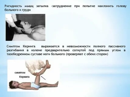 Мышечная ригидность что это