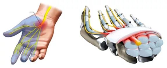 Операция карпального канала кисти. Синдром карпального канала операция. Синдром карпального канала кисти. Блокада карпального канала.