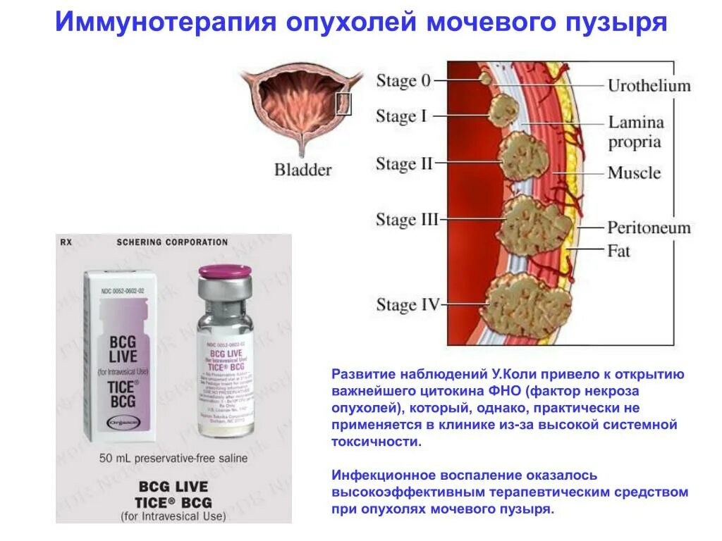 Рак мочевого химиотерапия. Иммунотерапия мочевого пузыря. Иммунотерапия БЦЖ мочевого пузыря. Иммунотерапия при онкологии препараты. Иммунная терапия в онкологии.