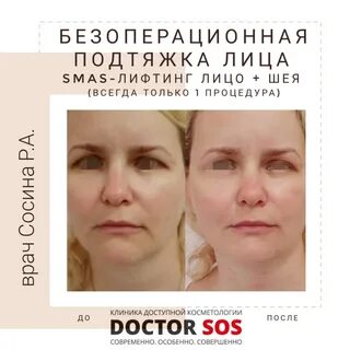 S лифтинг отзывы