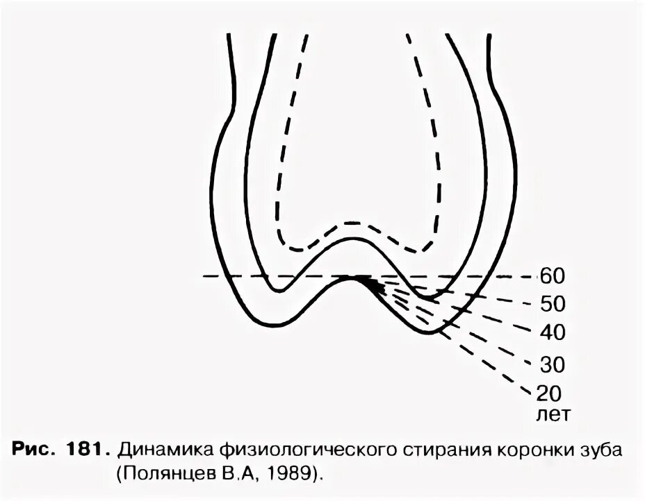 Как выглядит стираемость зубов Стираемость зубов