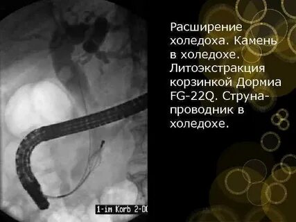 Холедоха