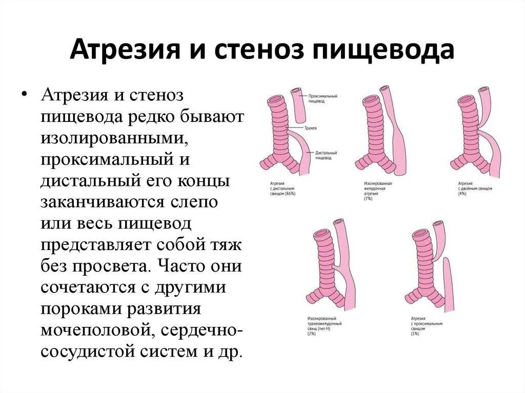 Атрезия пищевода. Врожденные аномалии развития пищевода. анатомические формы атрезии пищевода. атрезия пищевода с нижним трахеопищеводным свищом. аномалии развития пищевода у детей.