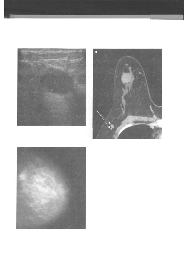 Медулярный рак. Злокачественная опухоль. Злокачественная фиброма. Лучевая маммология.