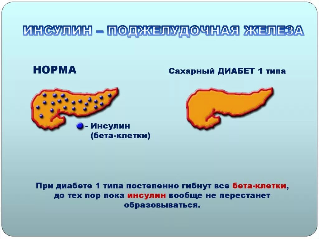 Пересадка поджелудочной при диабете. Сахарный диабет 1 типа поджелудочная железа. Поджелудочная железа при сахарном диабете 1 типа. Сахарный диабет 1 типа функции поджелудочной. Изменения поджелудочной железы при сахарном диабете 1 типа.