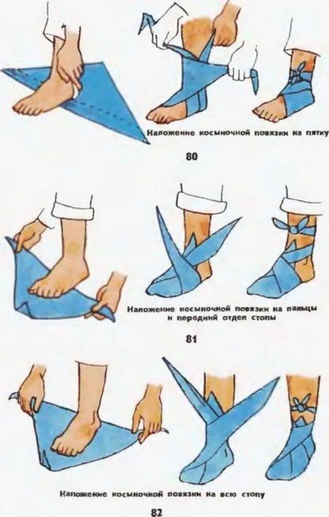 Перевязка перелома лодыжки алгоритм. Алгоритм косыночной повязки на стопу. Косыночная повязка бинтом. Техника наложения косыночной повязки.