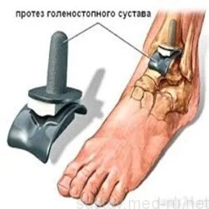 Перелом голеностопного сустава восстановление