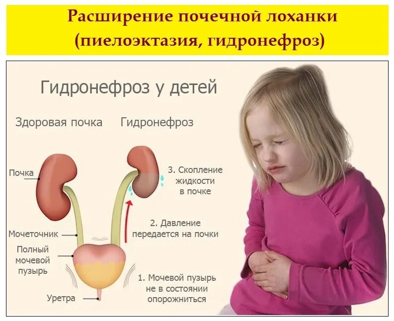 Гидронефроз почки у ребенка симптомы. Гидронефроз левой почки у ребенка.