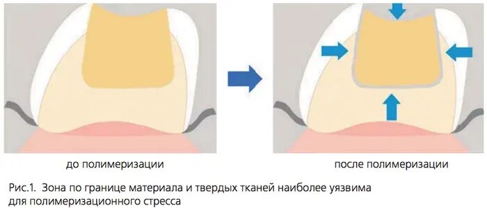 Фотополимеризация композита. Полимеризация пломбы. Пломбы фотоотверждаемые композиты. Полимеризация пломбы. Световая пломба композит.