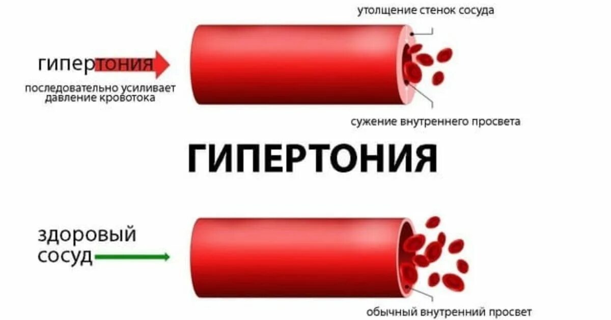 Гипотония сосудов. Артериальная гипертензия сосуды. Изменения в сосудах при гипертонии. Изменения сосудов при гипертонической болезни.