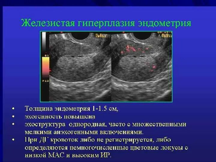 Гипопластическая эндометрия. Неатипическая гиперплазия эндометрия. Железистая гиперплазия на УЗИ. УЗИ признаки гиперплазии эндометрия. Гиперплазия эндометрия УЗИ критерии.