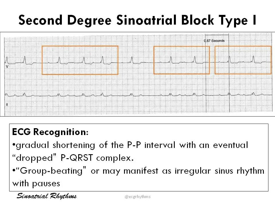 Second degree. Second degree. Second degree. Second degree av block type 2. Price discrimination 3 types.