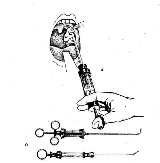 Тонзиллит аппарат. Методика промывания лакун небных миндалин шприцом. Тонзиллор промывание миндалин. Тонзиллит промывание миндалин вакуумным методом. Промывание лакун миндалин вакуумным методом.
