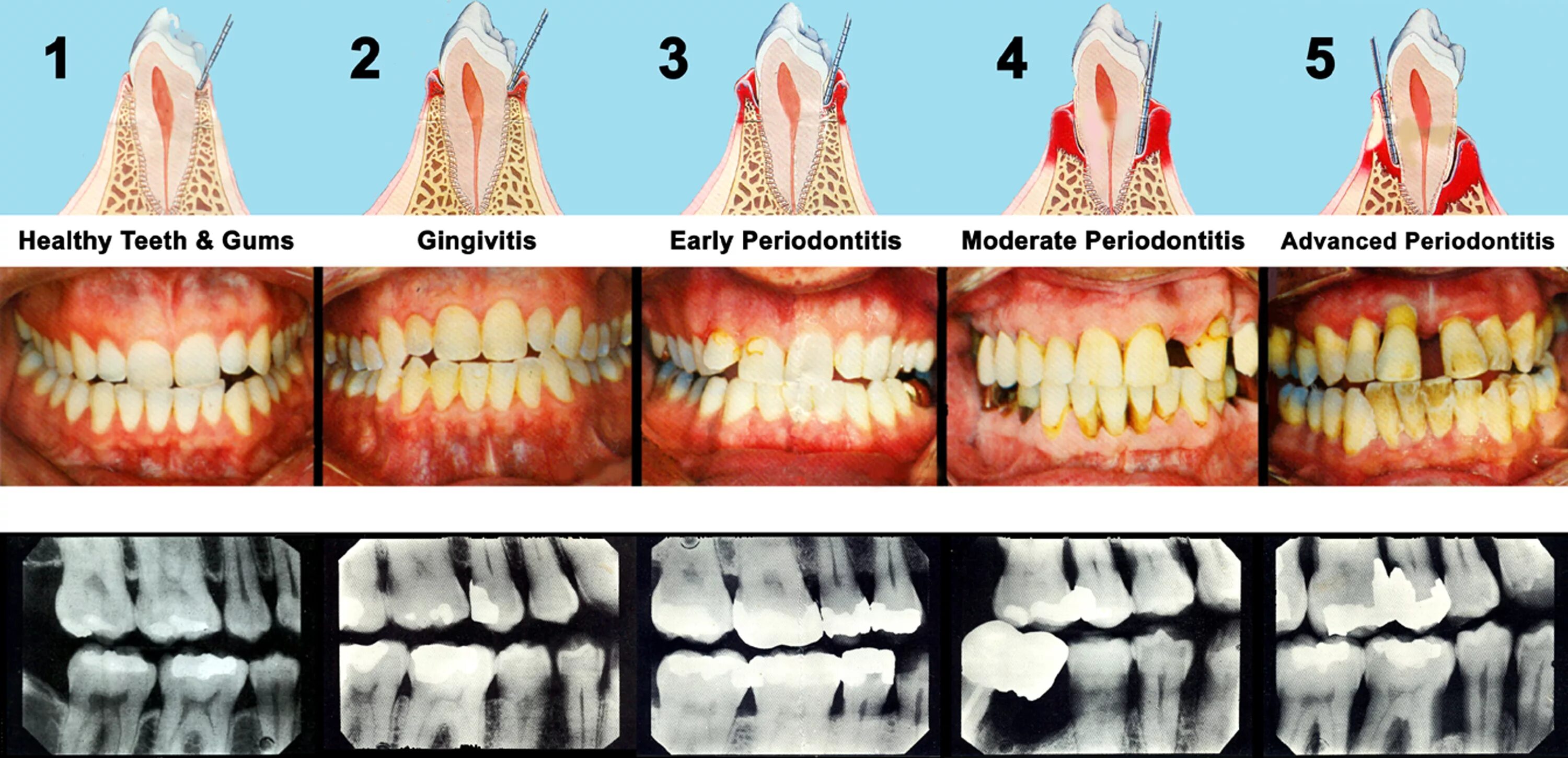 Чувствительность зубов после лечения. Язвенно некротический гингивит. Воспаление десен пародонтит.