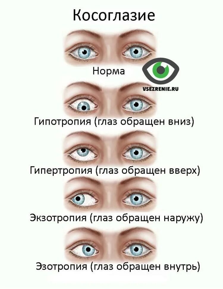 Косоглазие. Косоглазие у детей. Виды косоглазия. Расходящееся косоглазие. Почему мешает в глазах