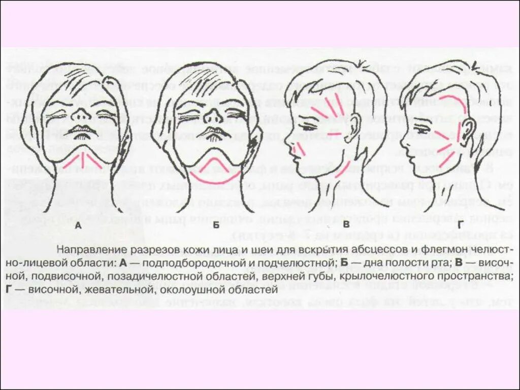 Операция абсцесс шеи. Разрезы для вскрытия абсцессов шеи. Разрезы для вскрытия флегмон шеи. Разрезы при флегмонах лица.