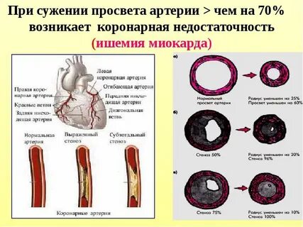 Интрамуральная гематома аорты