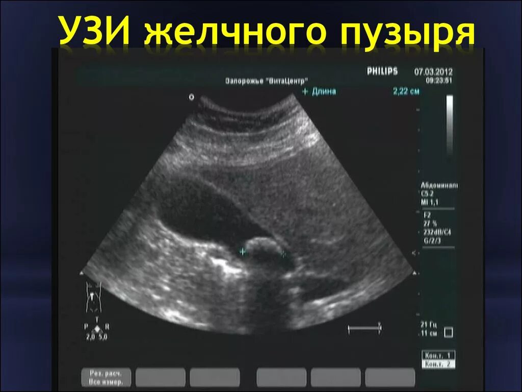 Определение сократимости желчного пузыря. УЗИ С определением сократительной способности желчного пузыря. Норма желчного пузыря на УЗИ У детей. Нормальный желчный пузырь на УЗИ. Ультразвуковое исследование желчный пузырь норма.