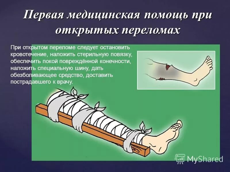 Как оказать первую медицинскую помощь при переломе. Оказание первой мед помощи при ушибах и переломах. Оказание первой помощи при переломе ноги. Первая помощь припереломаз.